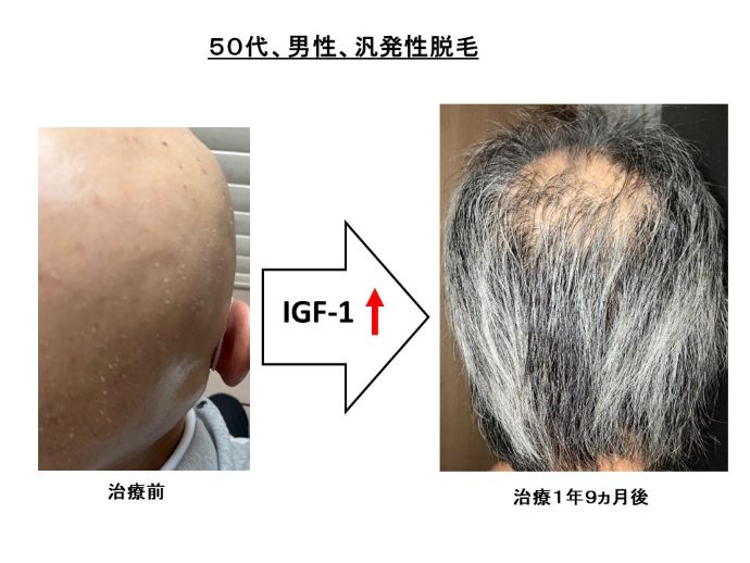 円形脱毛症　病院